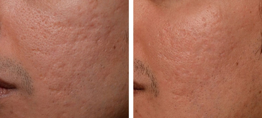 Laser cheek skin resurfacing treatment before and after at Kingsway Dermatology