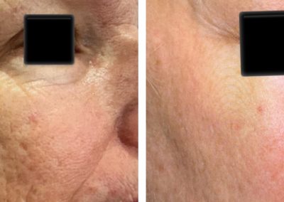 Cheek laser skin resurfacing before and after at Kingsway Dermatology