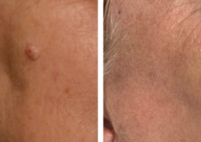 Cheek laser skin resurfacing before and after at Kingsway Dermatology