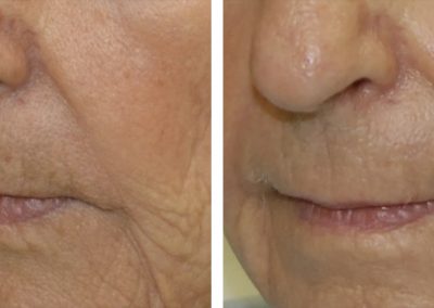 Cheek laser skin resurfacing before and after at Kingsway Dermatology