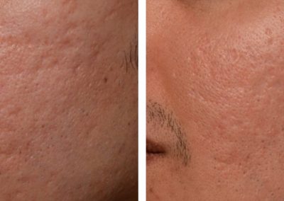 Enlarge pores and cheeks treatment at Kingsway Dermatology