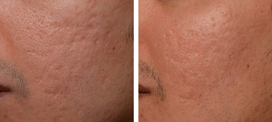 Enlarge pores and cheeks treatment at Kingsway Dermatology