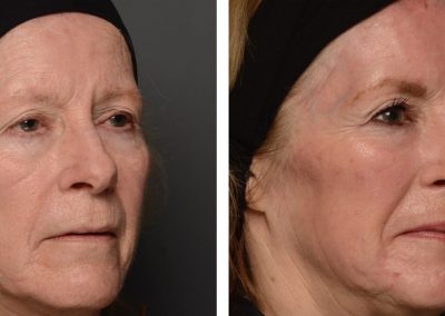 Cheek laser skin resurfacing before and after at Kingsway Dermatology