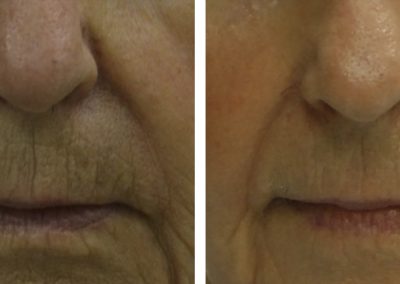 Cheek laser skin resurfacing before and after at Kingsway Dermatology