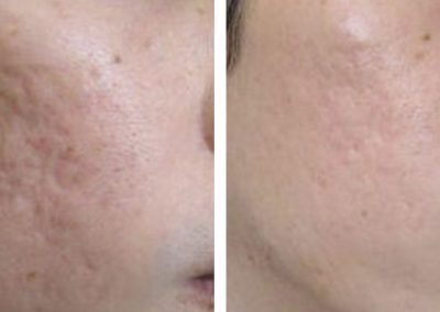 Microneedling treatment before and after at Kingsway Dermatology