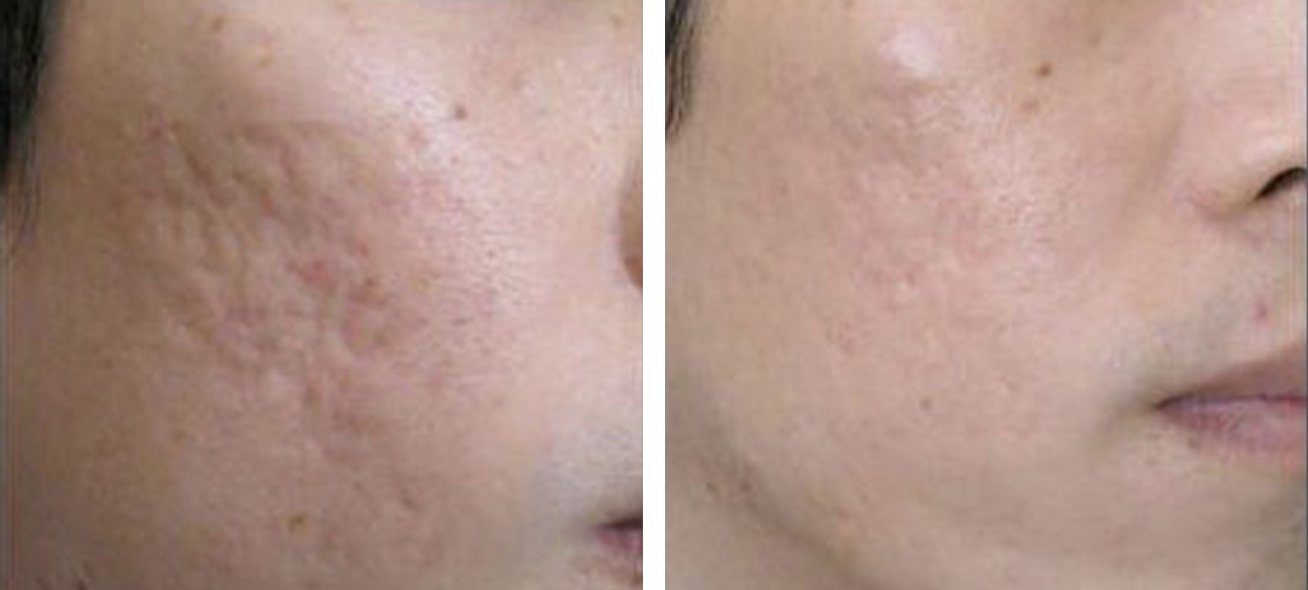 Microneedling treatment before and after at Kingsway Dermatology