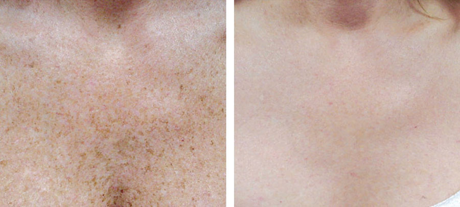Neck and chest before and after treatment at Kingsway Dermatology