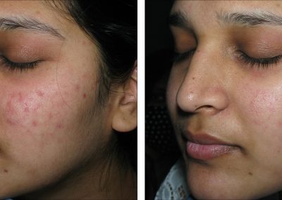 Before and After Microneedling Treatment