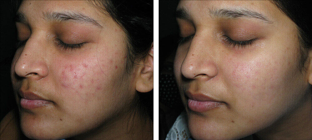 Before and After Microneedling Treatment