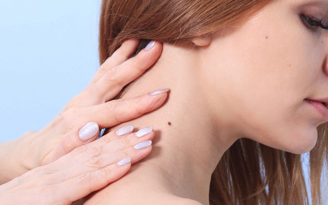 Understanding Benign Skin Lesions
