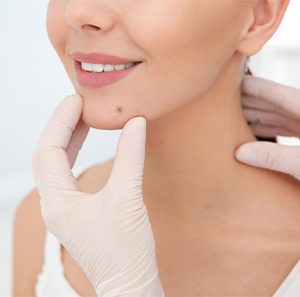 Chin skin lesion treatment at Kingsway Dermatology
