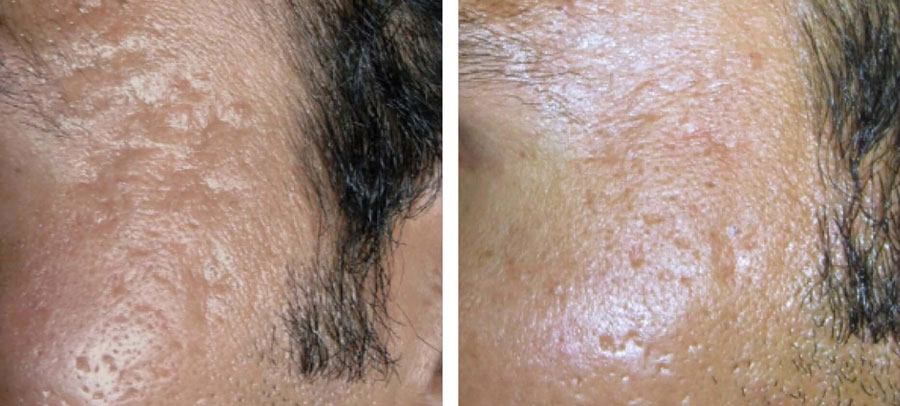 Acne and Acne Scars before and after at Kingsway Dermatology