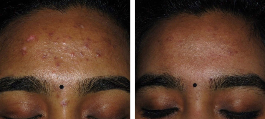 Acne and Acne Scars before and after at Kingsway Dermatology