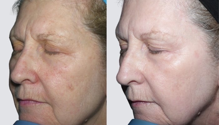 before and after brown spots
