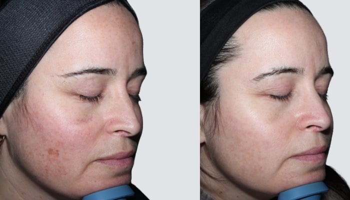 before and after brown spots toronto