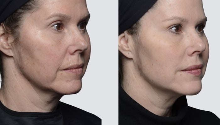 before and after jowls treatment toronto