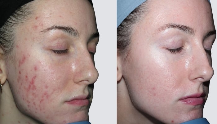 before and after microneedling toronto