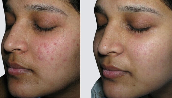 before and after microneedling toronto