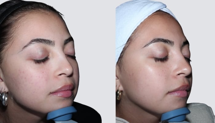 before and after microneedling toronto
