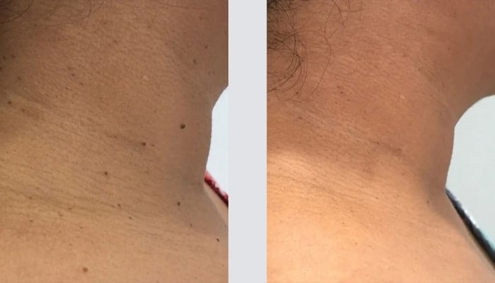 before and after moles and tag removal