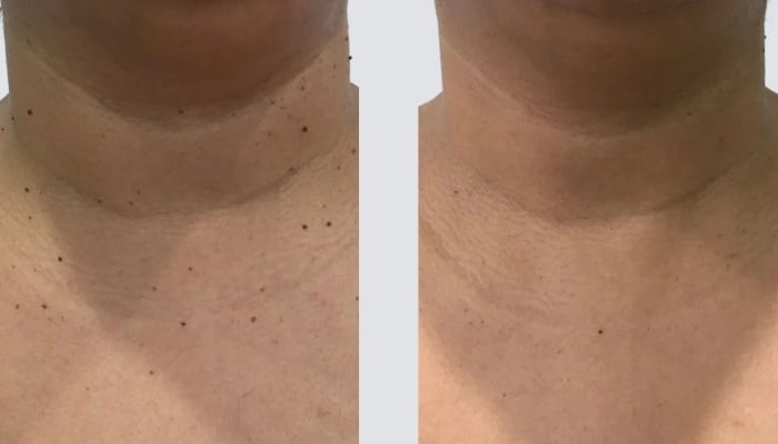 before and after moles and tag removal